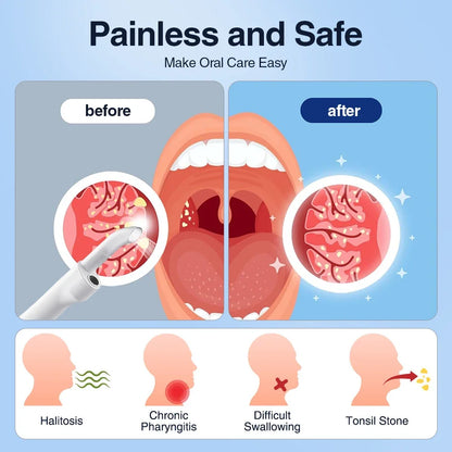 ClearView Pro Electric Visual Tonsil Stone Remover
